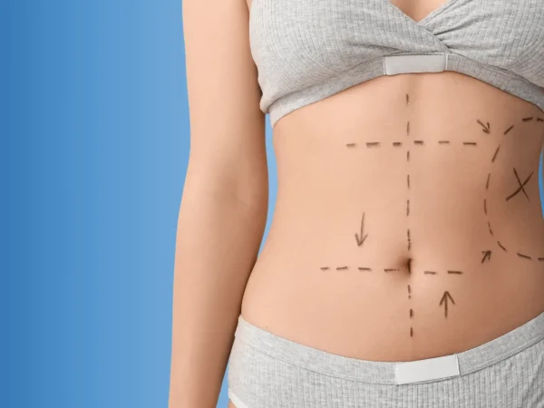 Tummy Tuck in Dubai