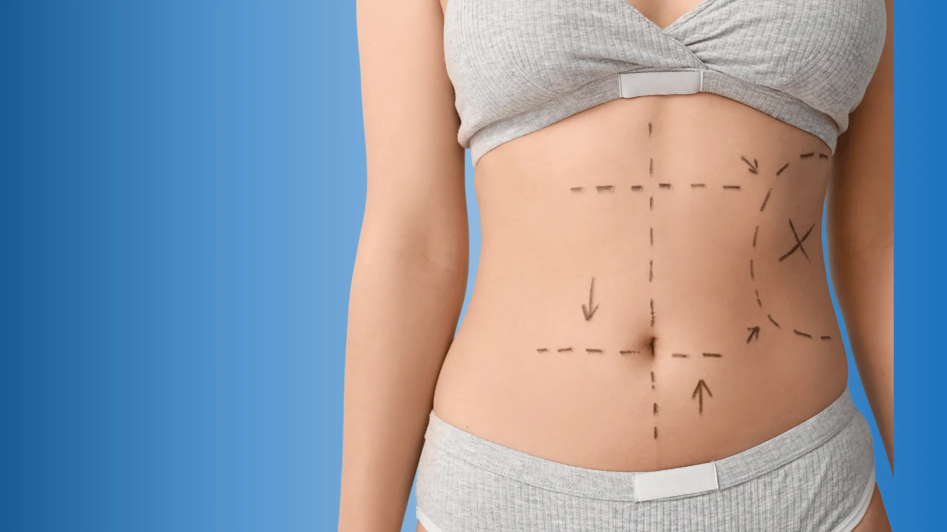 Tummy Tuck in Dubai