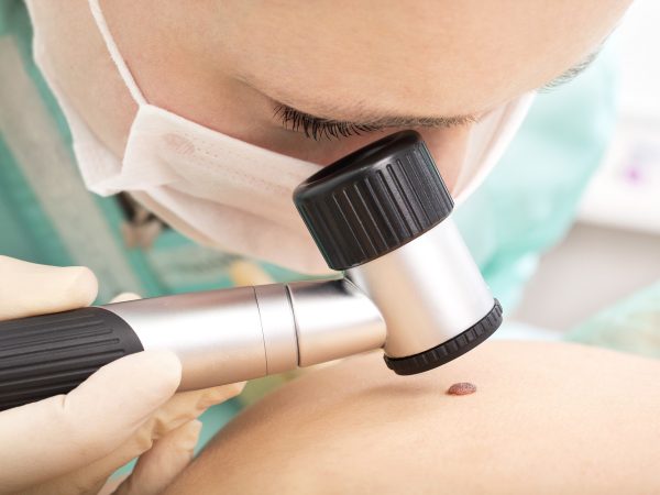 What are the Results of a Dermoscopy Mole Evaluation?