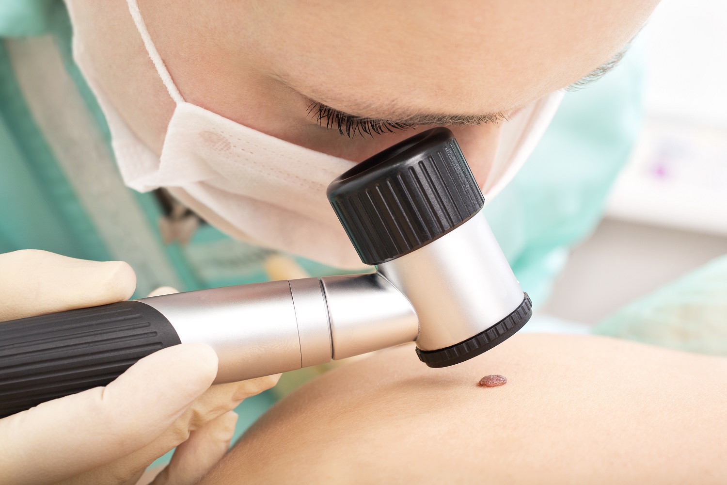 What are the Results of a Dermoscopy Mole Evaluation?